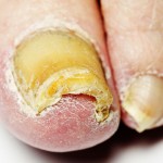 toe needing toenail fungus removal_12956052_m