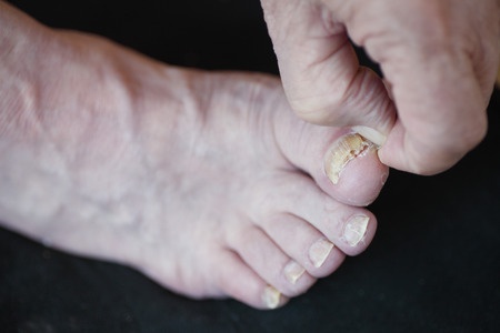 gomba betegségek nail foot
