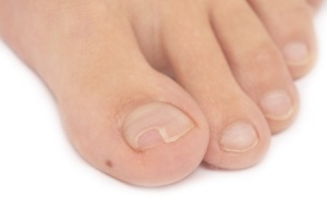 toenail fungus removal home remedies_23133574_s