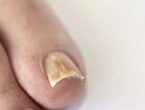 nail diseases_12433619_s