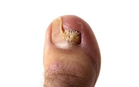 Nail Diseases Chart: Picture, Sign and Treatment